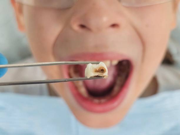 Best Emergency Broken Tooth Repair in Plattsburg, MO